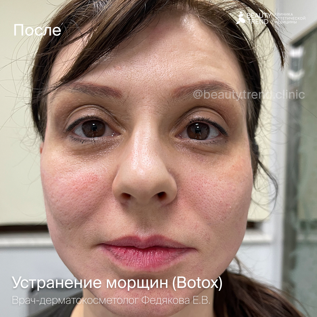 Устранение морщин Botox, Федякова - после